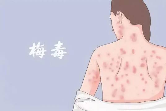 日本梅毒
