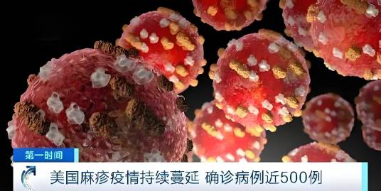 2025年美国麻疹疫情