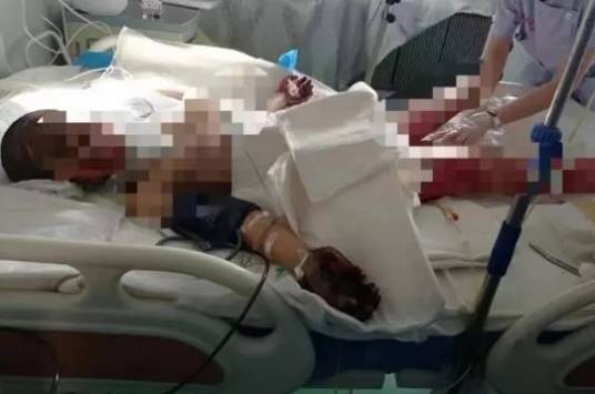 12·7丹东女孩被烧伤事件