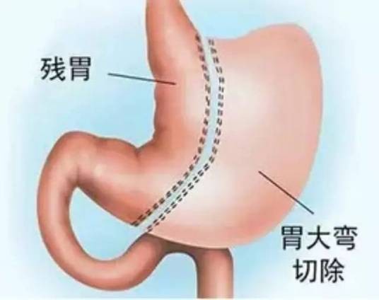 腹腔镜胃袖状切除术