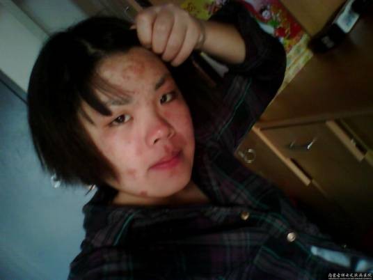 食源性运动诱发过敏症