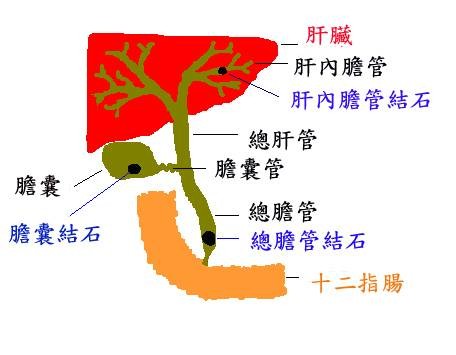 胆结石中药方剂