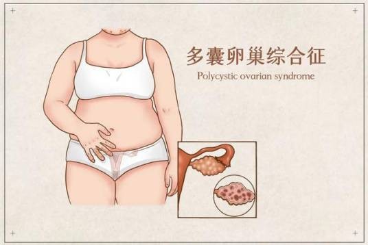 多囊卵巢综合征闭经