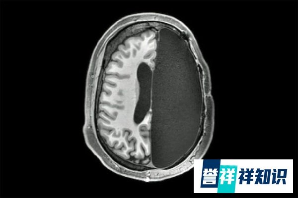 女子被“削”掉半个脑袋，几乎没有后遗症，竟非医学奇迹？