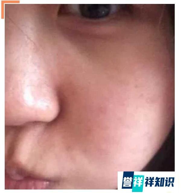 黑脸娃娃前后对比，案例分享