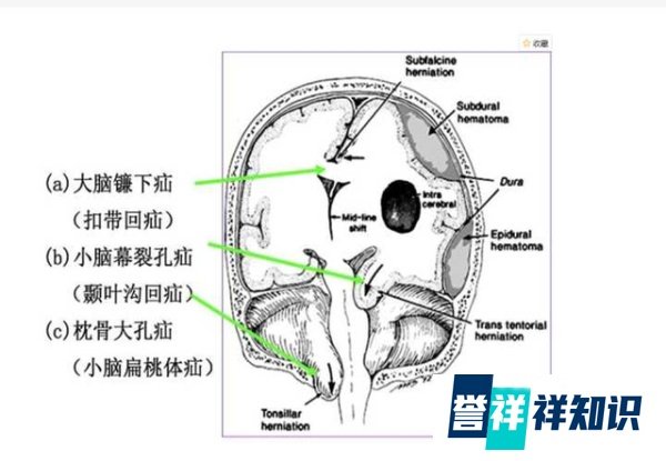 女子被“削”掉半个脑袋，几乎没有后遗症，竟非医学奇迹？