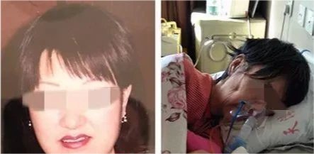 女商人抽脂成植物人，你觉得有必要为了美容冒险吗？