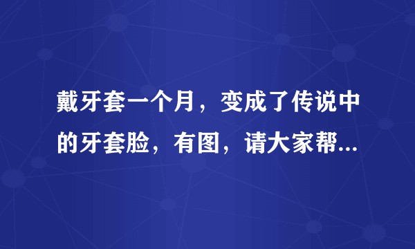 戴牙套一个月，变成了传说中的牙套脸，有图，请大家帮忙分析下原因？